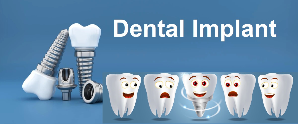Dental Implants - A Comprehensive Guide