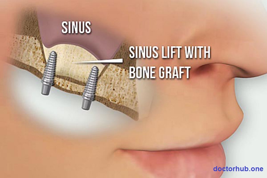 Sinus Complications |What You Need to Know About Upper Jaw Implants