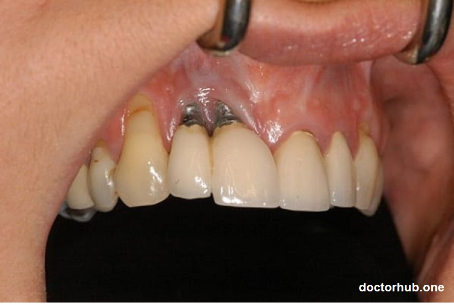 The Hidden Risks | Gum Recession and Implant Failure