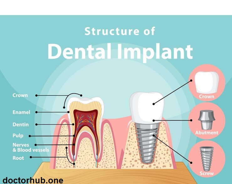 The Perfect Trio | Titanium Post, Abutment, and Crown