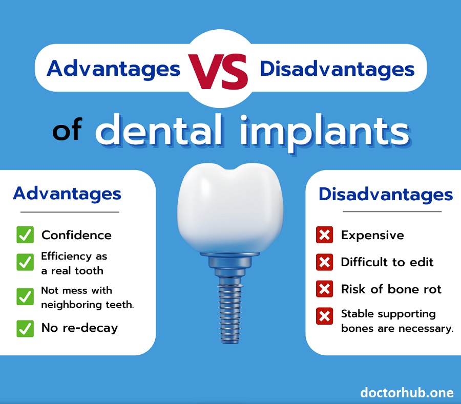 The Pros and Cons of Dental Implants