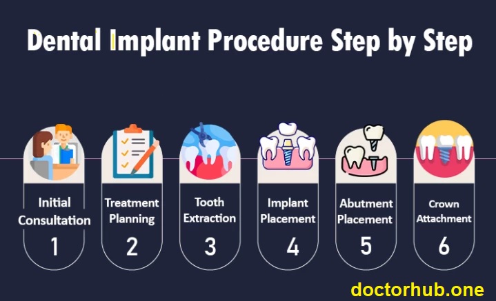 Step-by-Step Journey | Understanding the Dental Implant Procedure